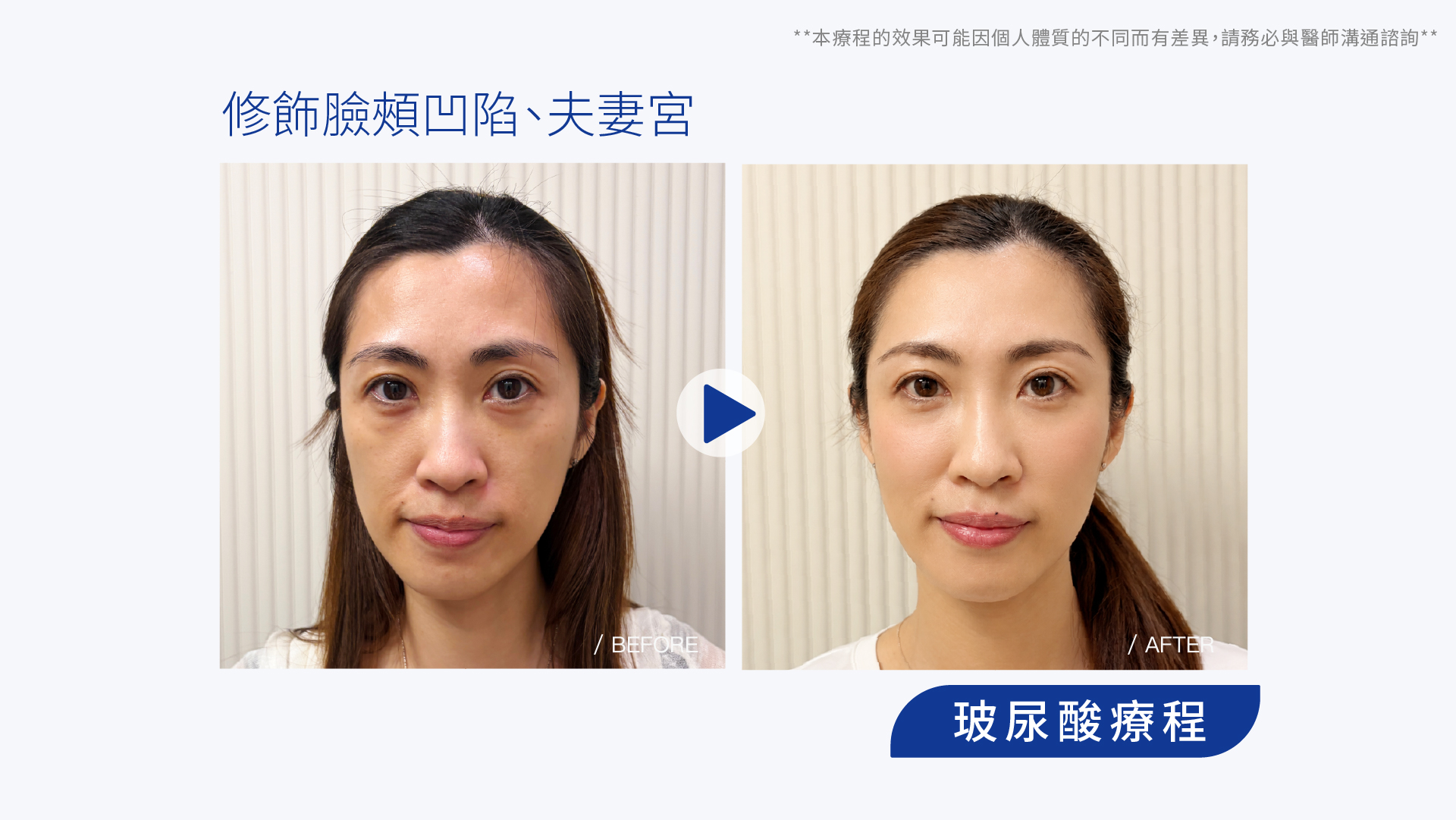 明明很好命，卻長得像苦命臉？我的玻尿酸填充心得