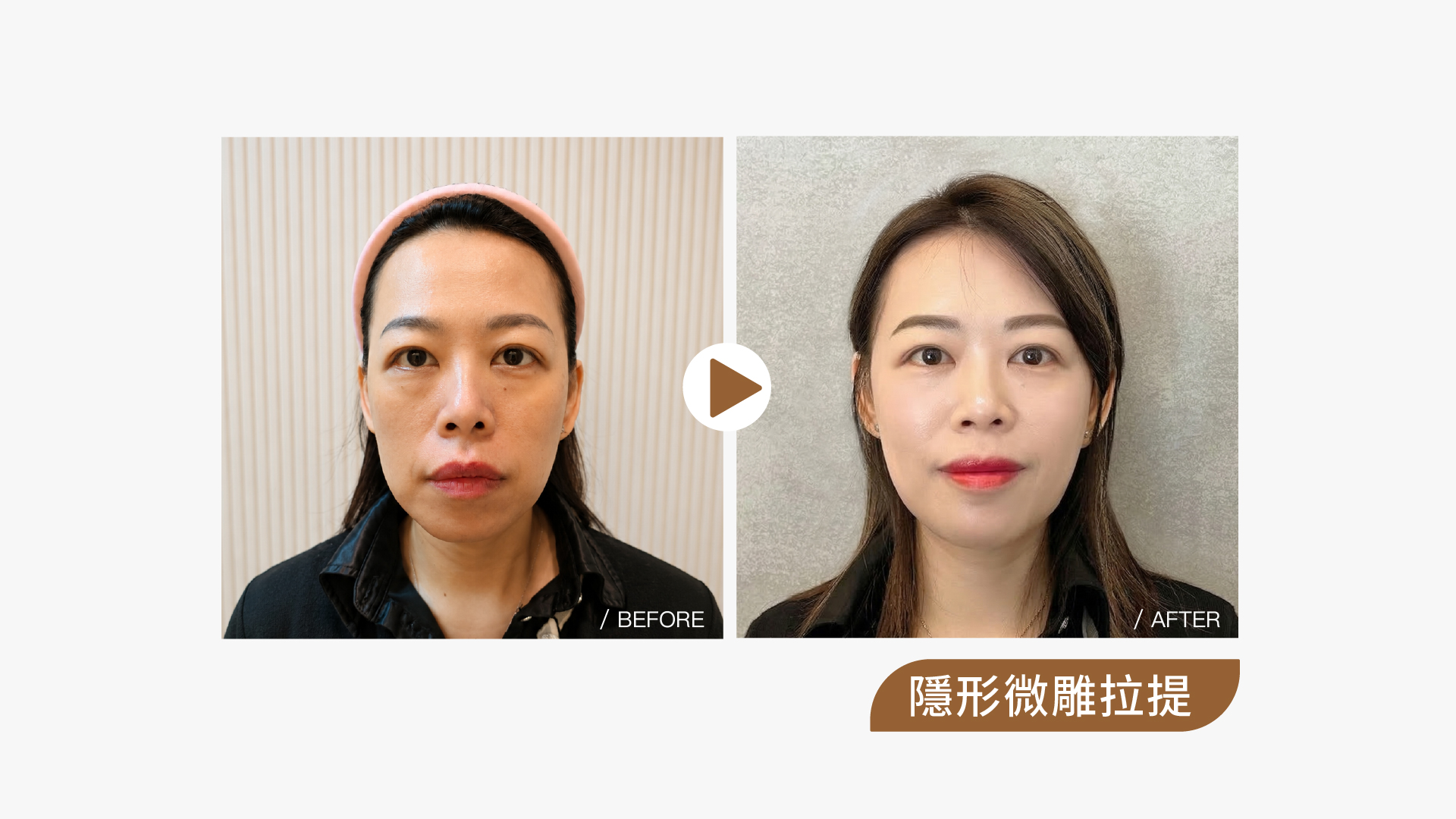 隱形微雕拉提