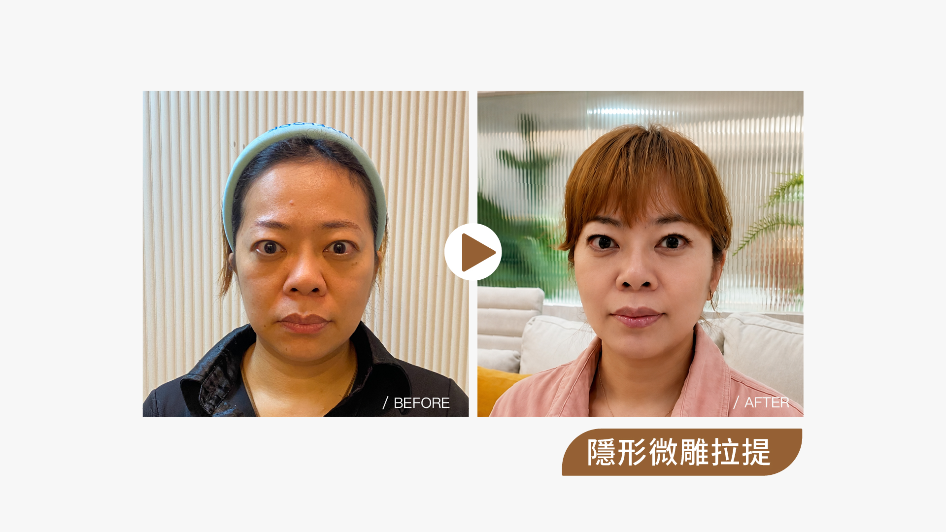 隱形微雕拉提