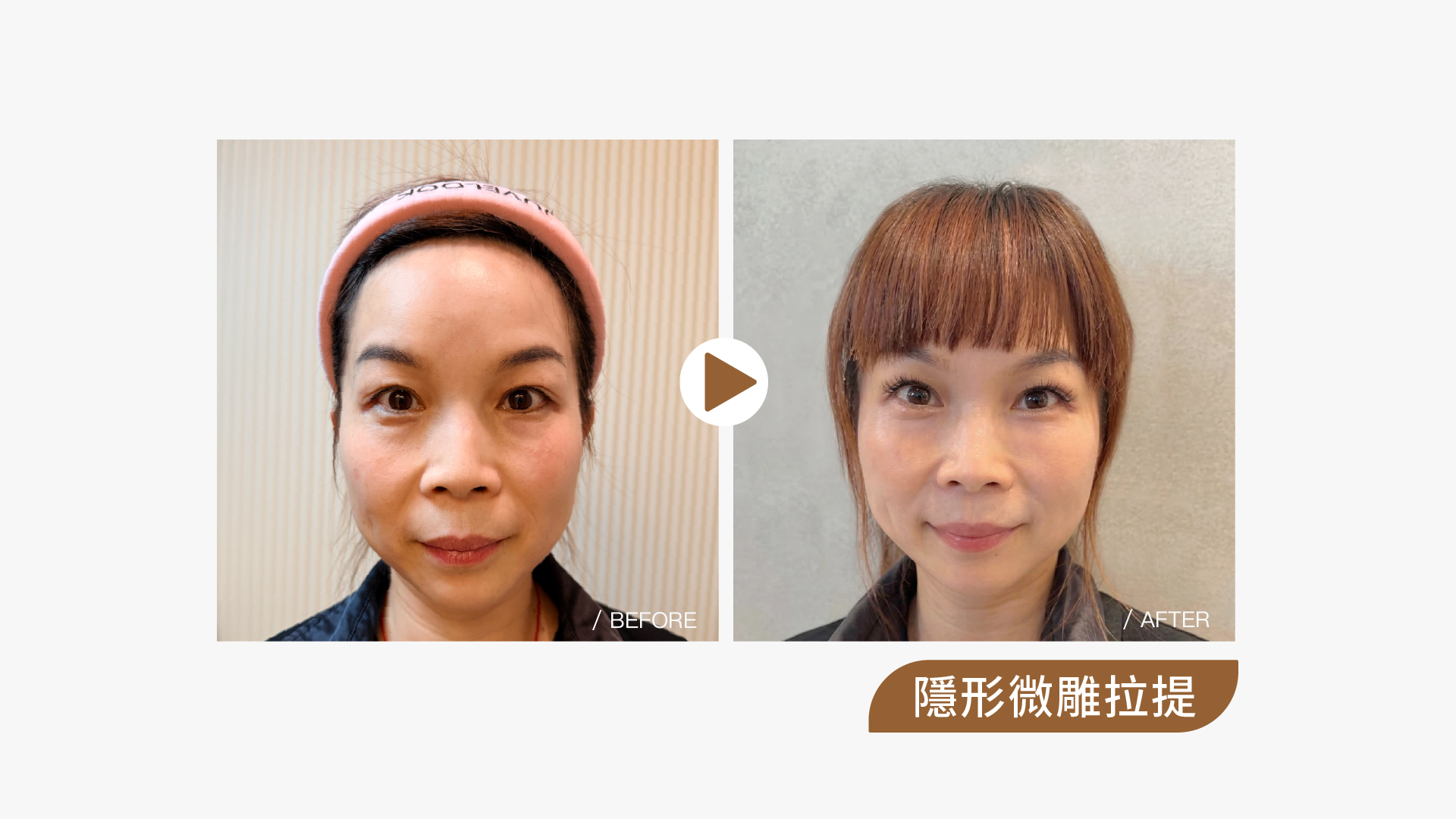 隱形微雕拉提