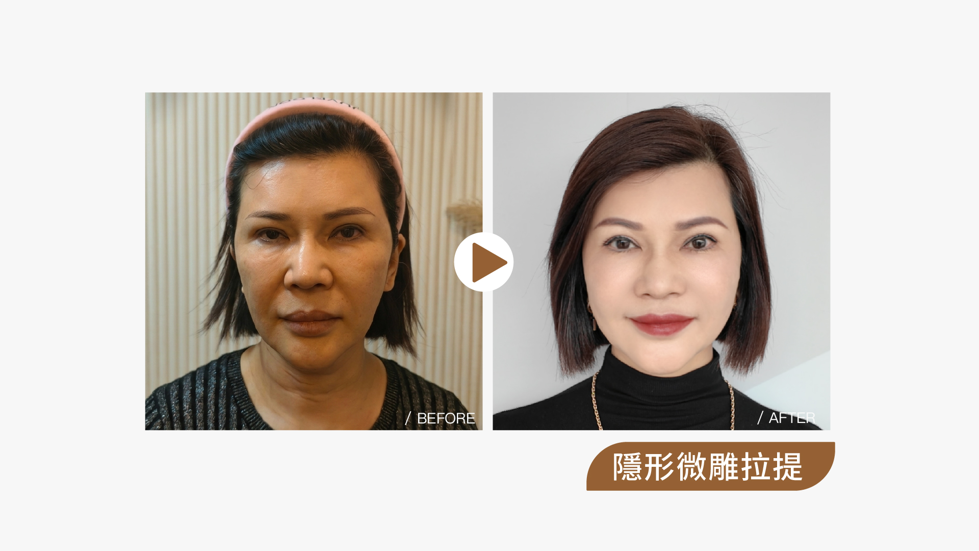 隱形微雕拉提