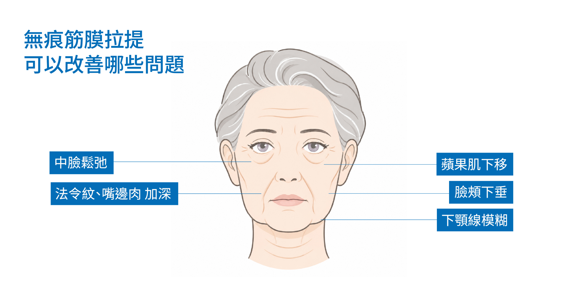 無痕筋膜拉提是什麼?一次了解原理、效果與適合族群