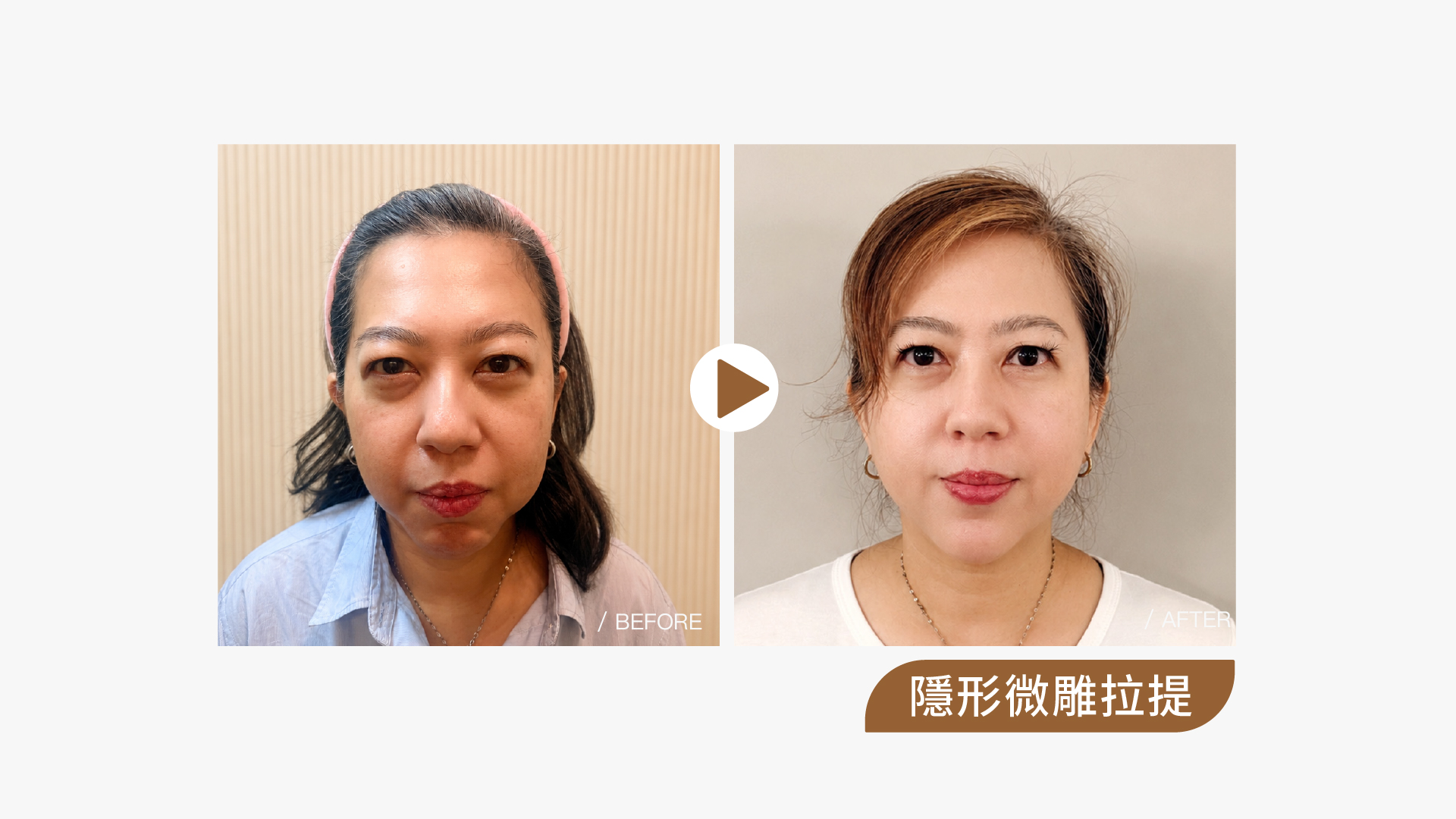 隱形微雕拉提