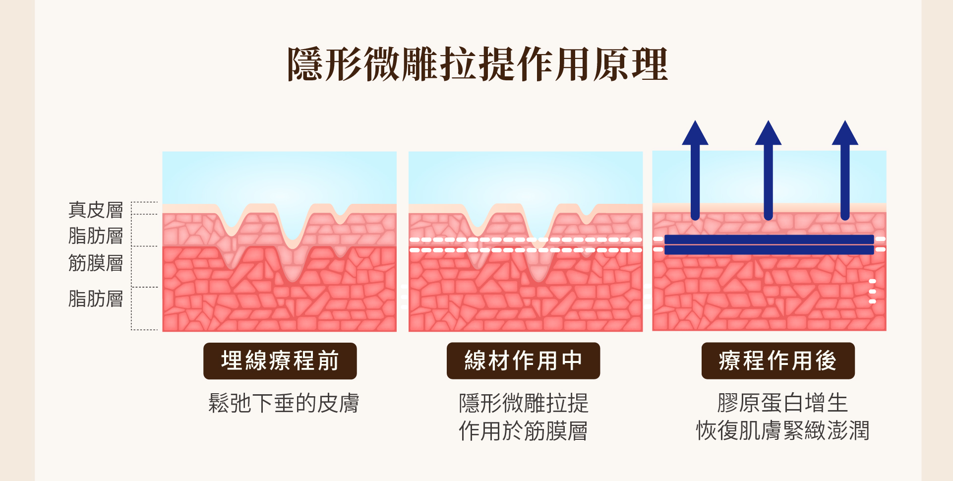 隱形微雕拉提