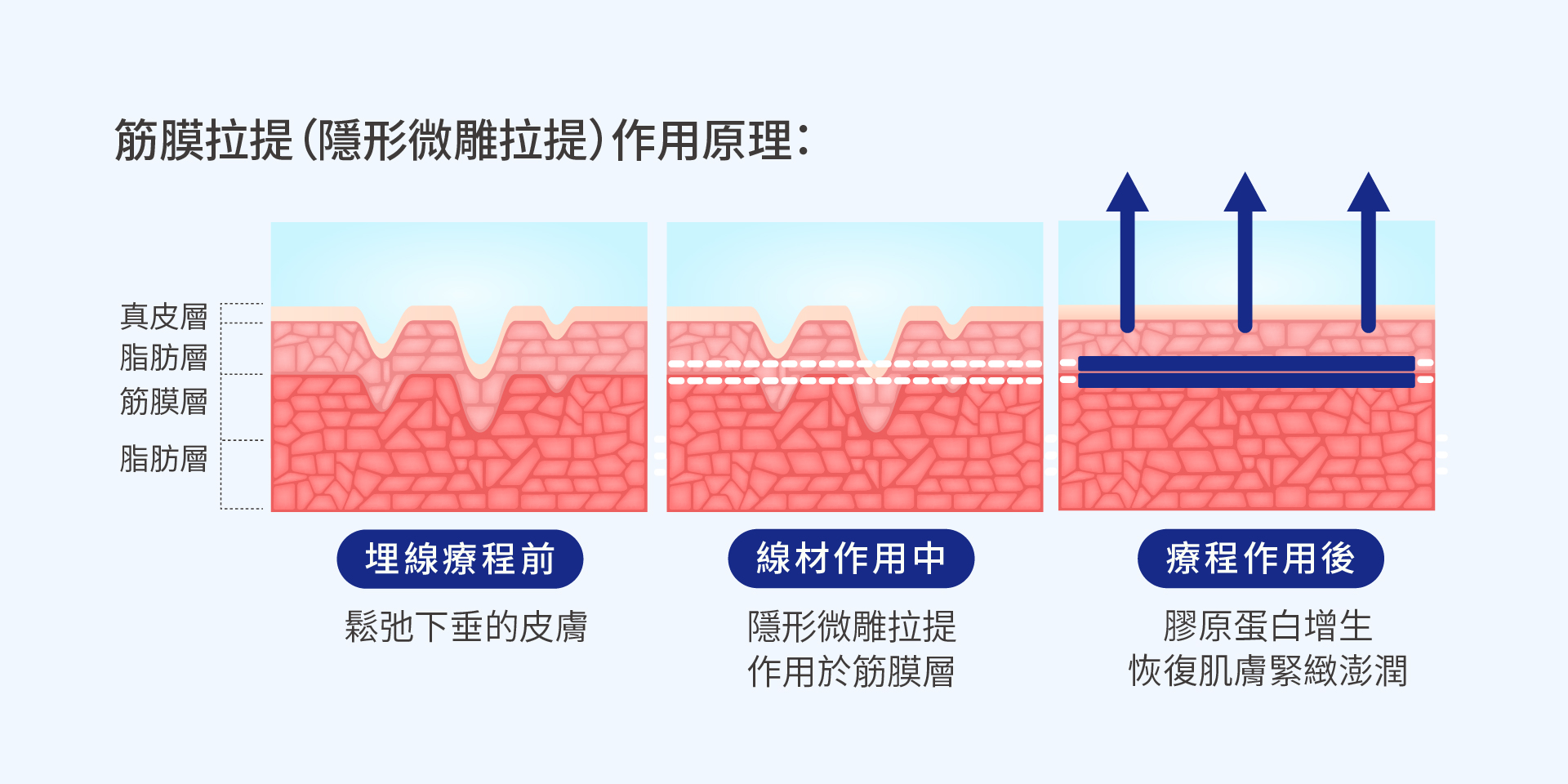 無痕筋膜拉提是什麼?一次了解原理、效果與適合族群