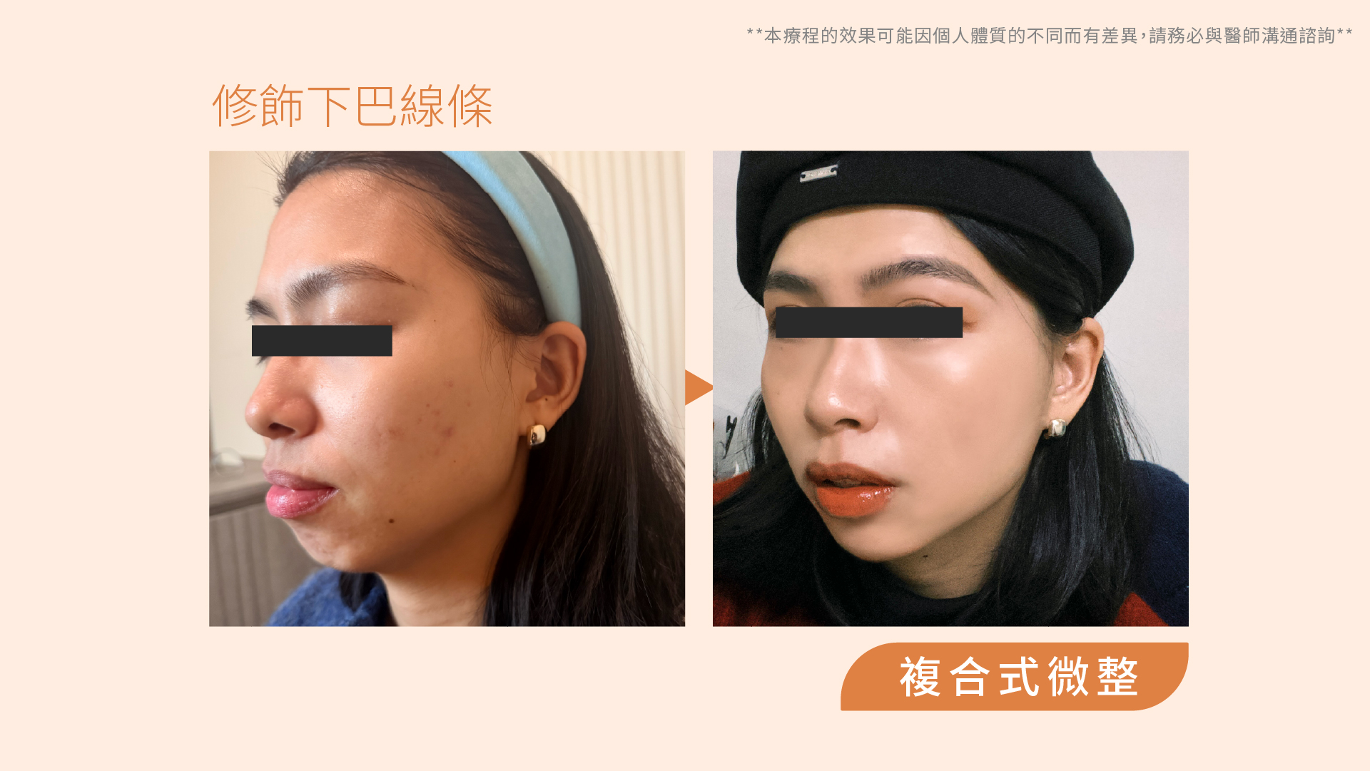 仙女玻尿酸