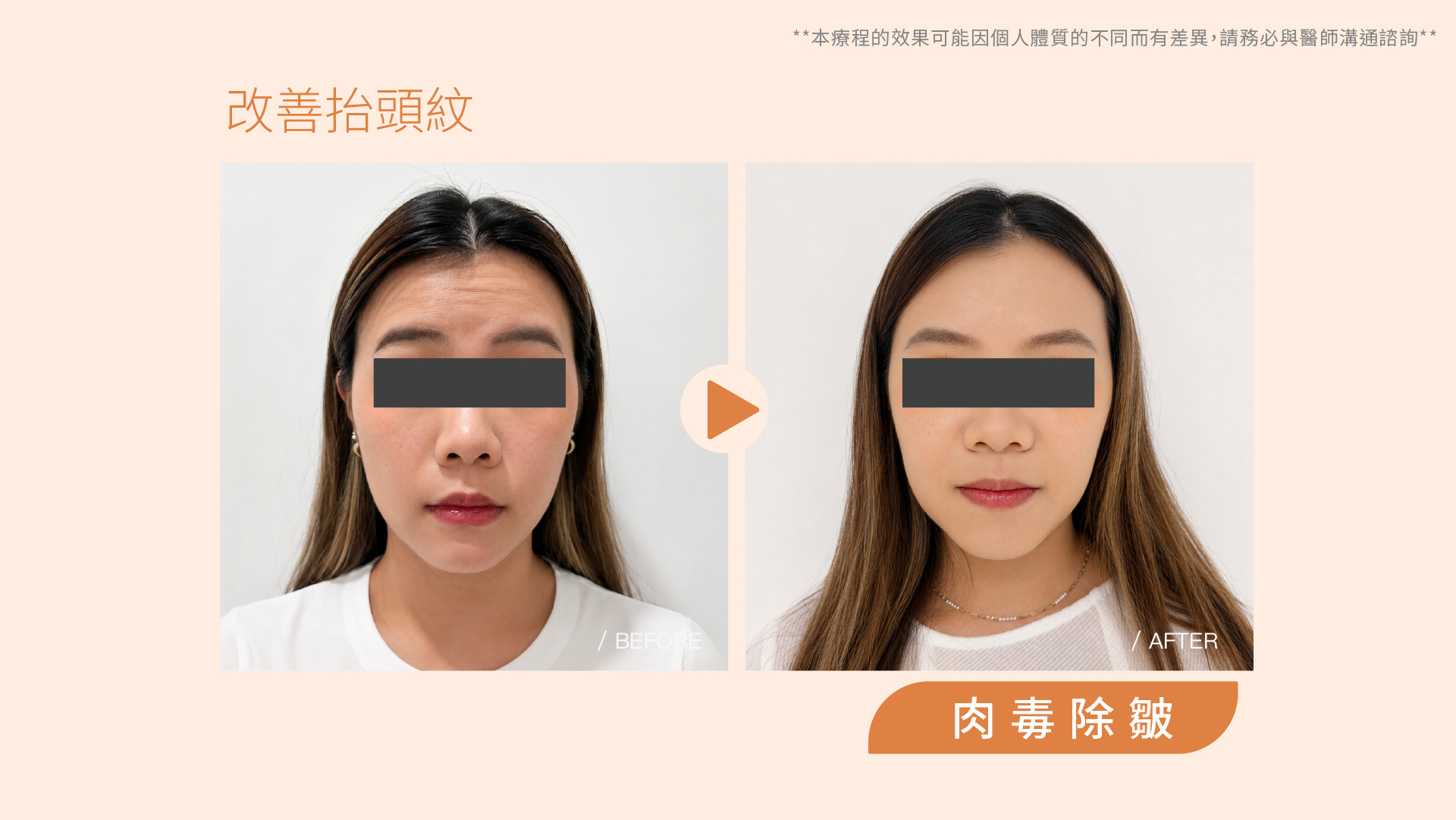 肉毒桿菌除皺／瘦小臉