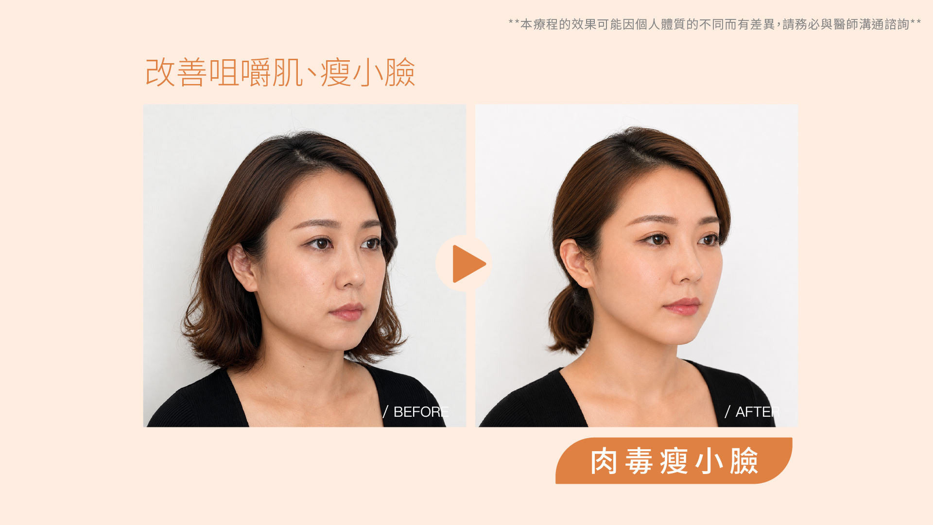 肉毒桿菌除皺／瘦小臉