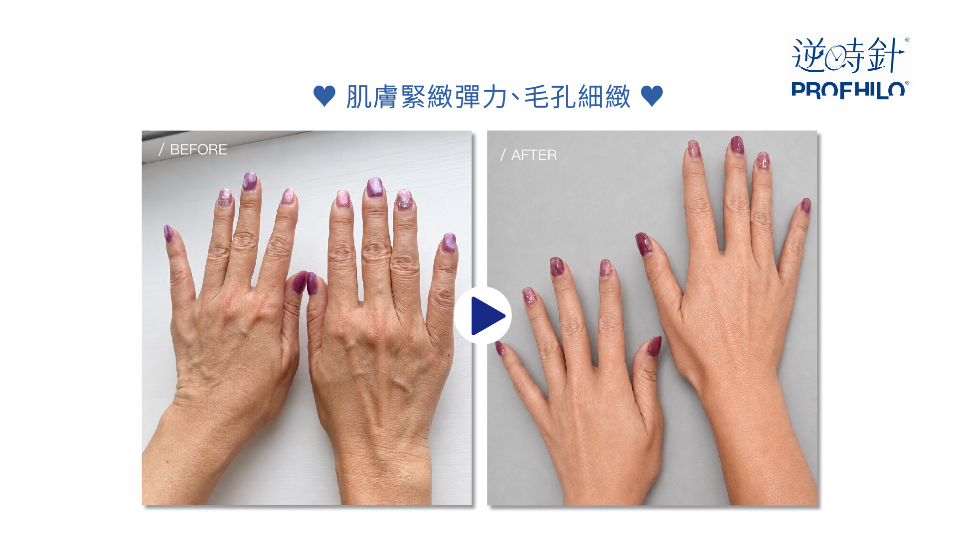 Profhilo 逆時針