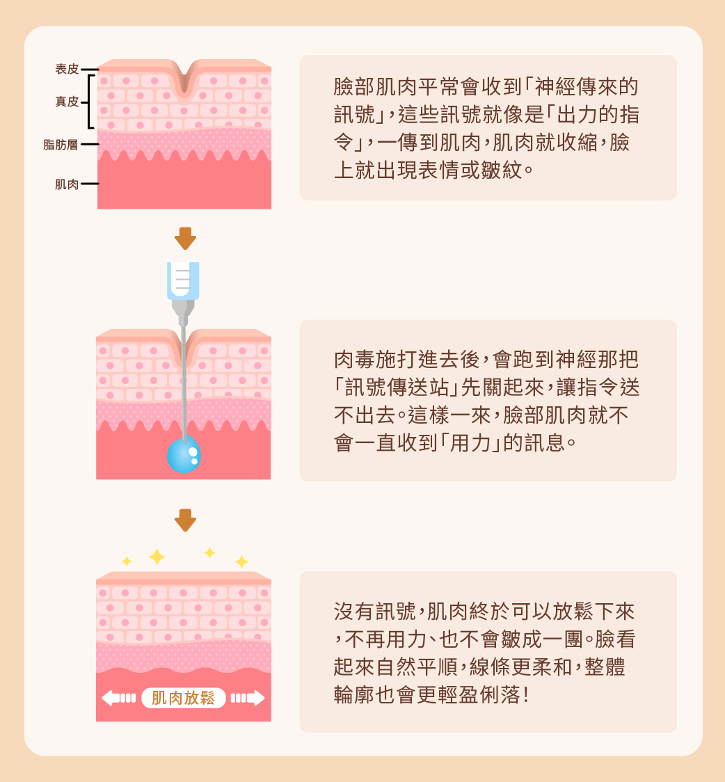 肉毒桿菌除皺／瘦小臉