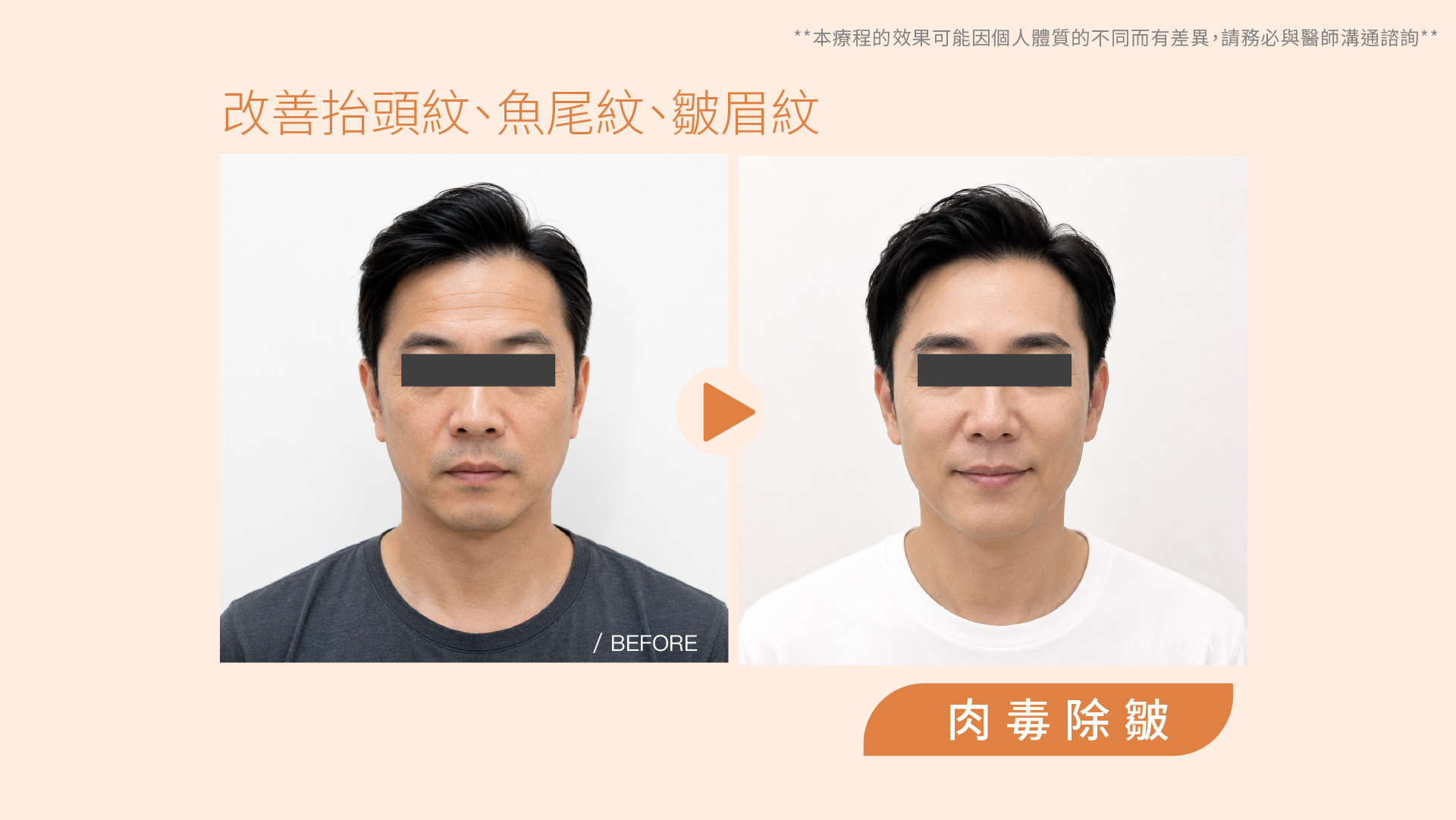 肉毒桿菌除皺／瘦小臉