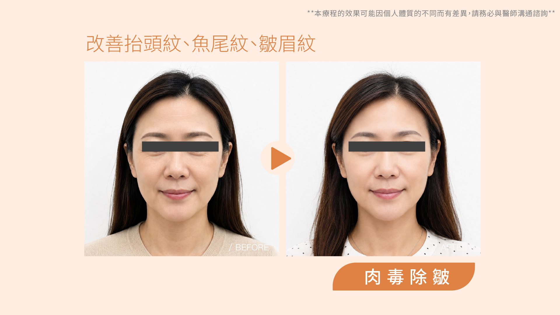 肉毒桿菌除皺／瘦小臉