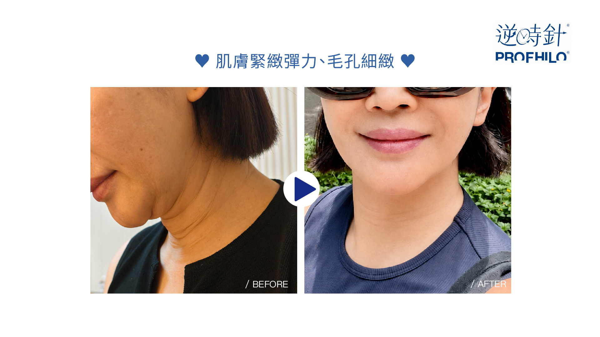 Profhilo 逆時針