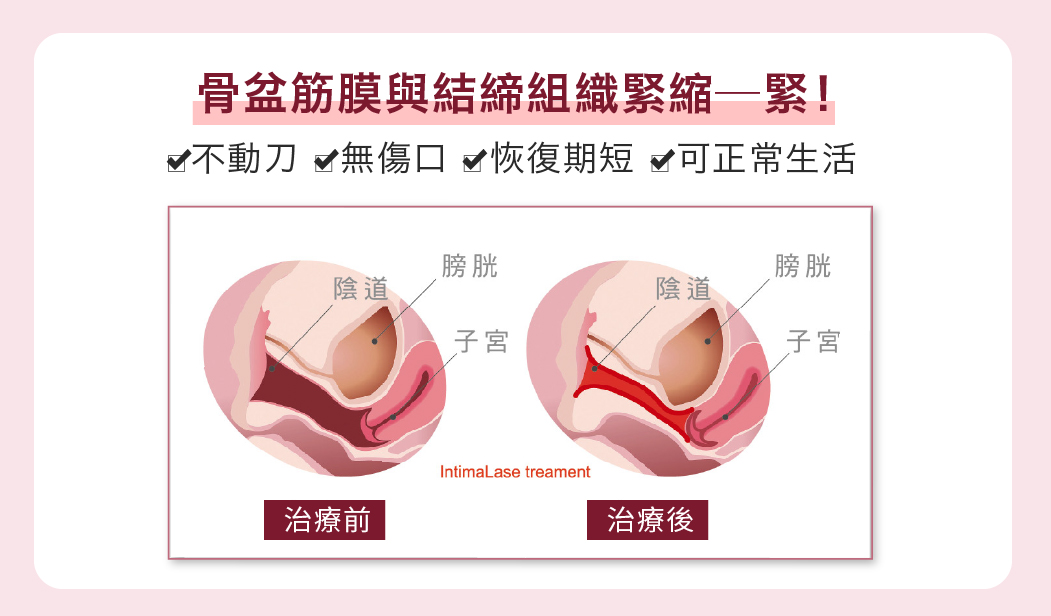 私密處緊緻雷射
