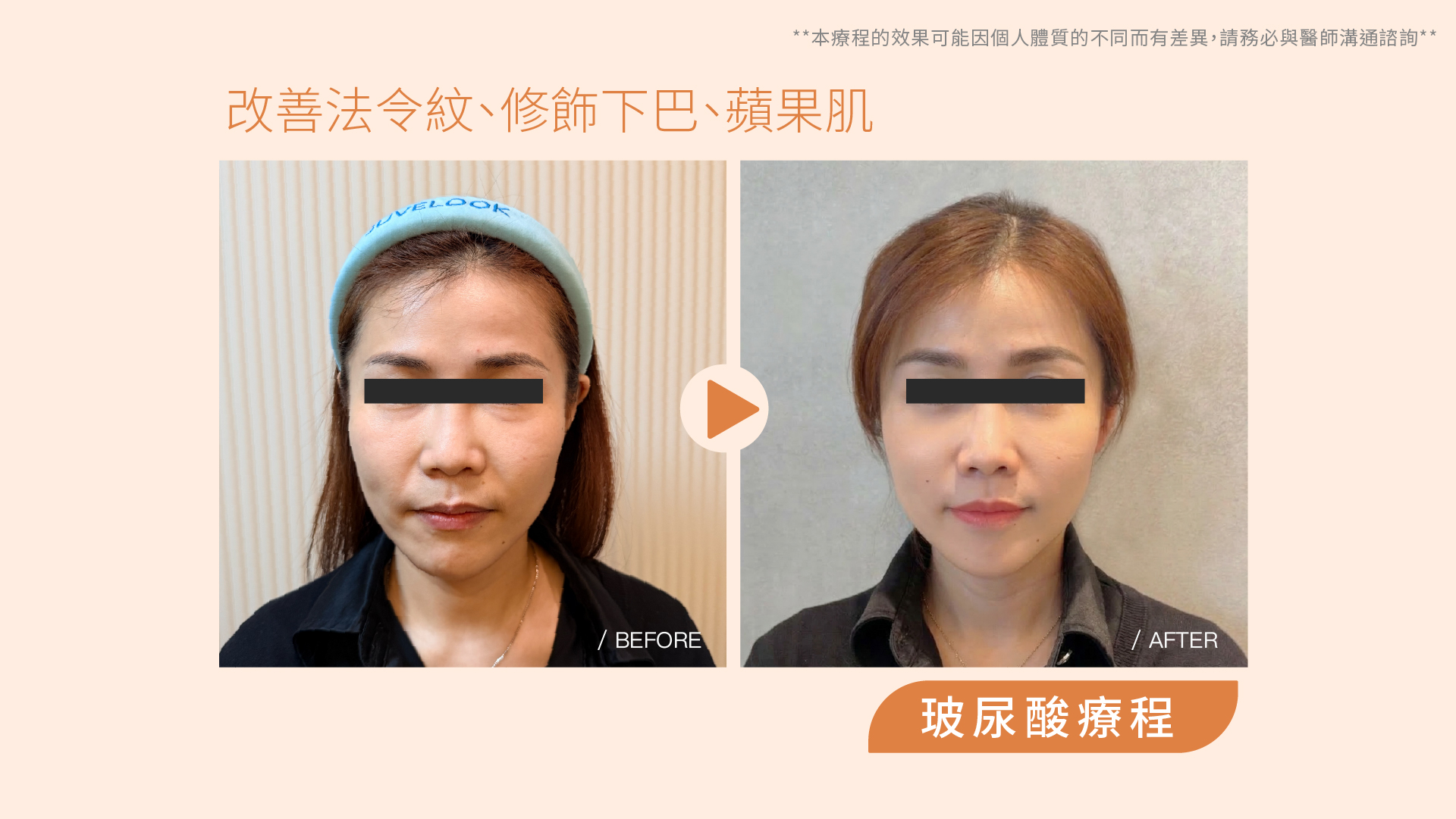 仙女玻尿酸