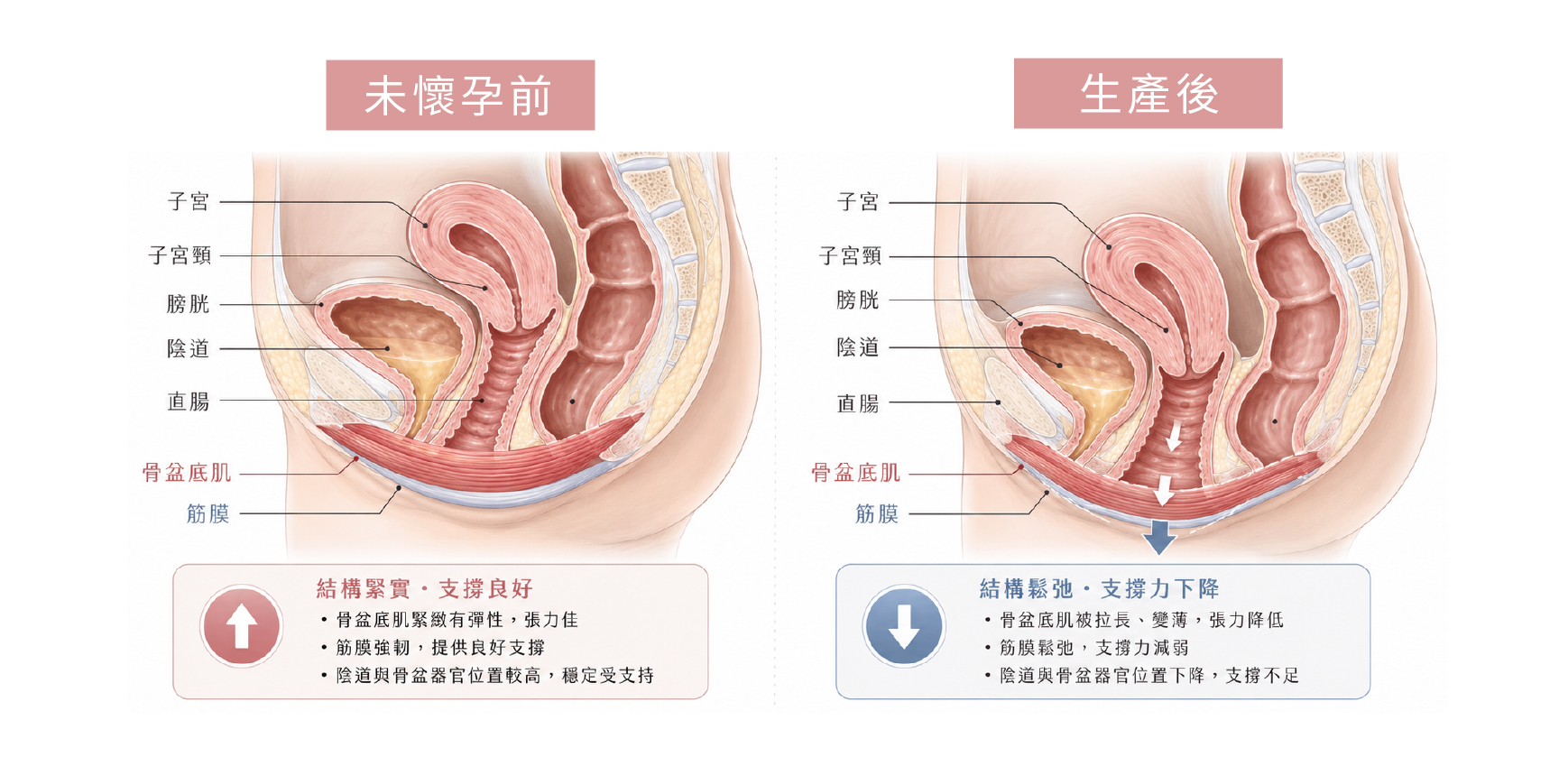 生產後陰道鬆弛怎麼辦？醫師解析原因與G緊雷射療程