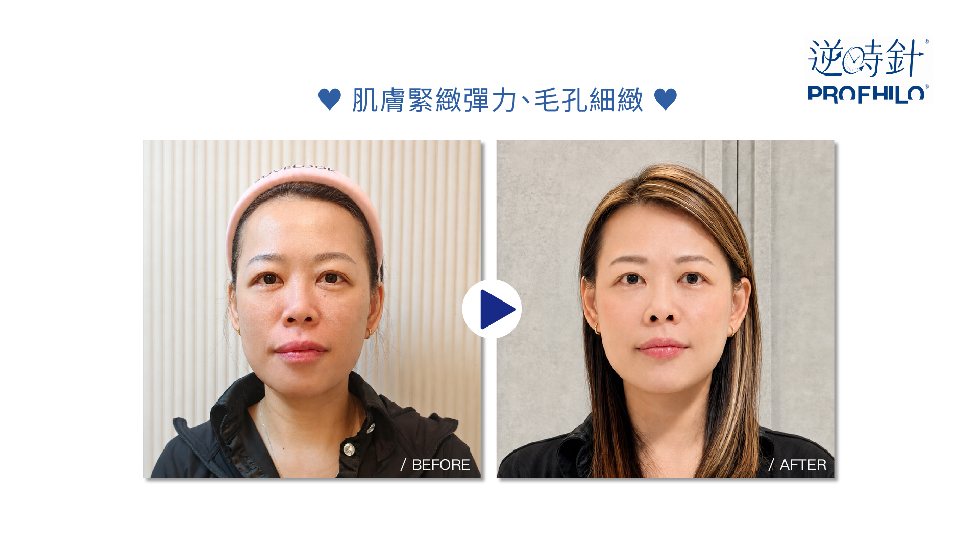 Profhilo 逆時針