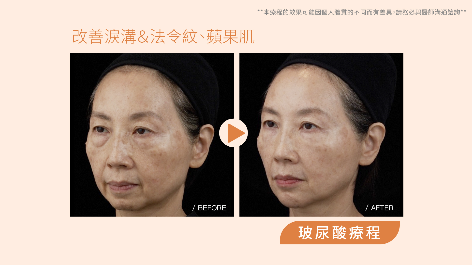 仙女玻尿酸