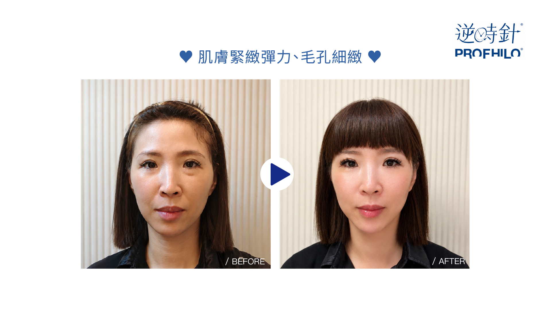Profhilo 逆時針